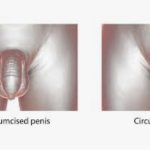 Sai tutto sulla circoncisione? Test