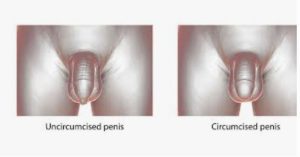 Sai tutto sulla circoncisione? Test