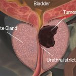 L’esperienza dell’intervento alla prostata
