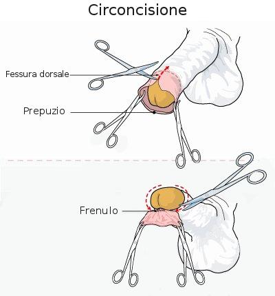 Sai tutto sulla circoncisione?